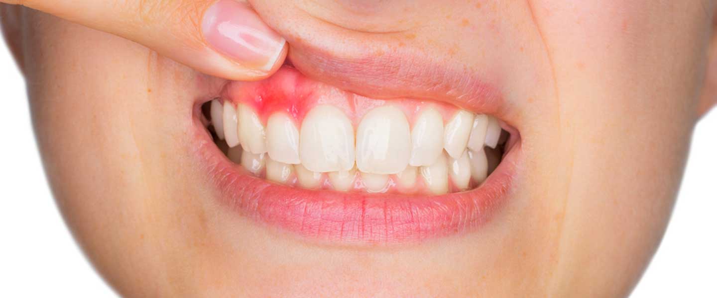 What Is Gum Disease What Is Gum Disease