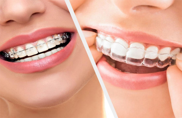 What is Orthodontic Treatment? What is Orthodontic Treatment?