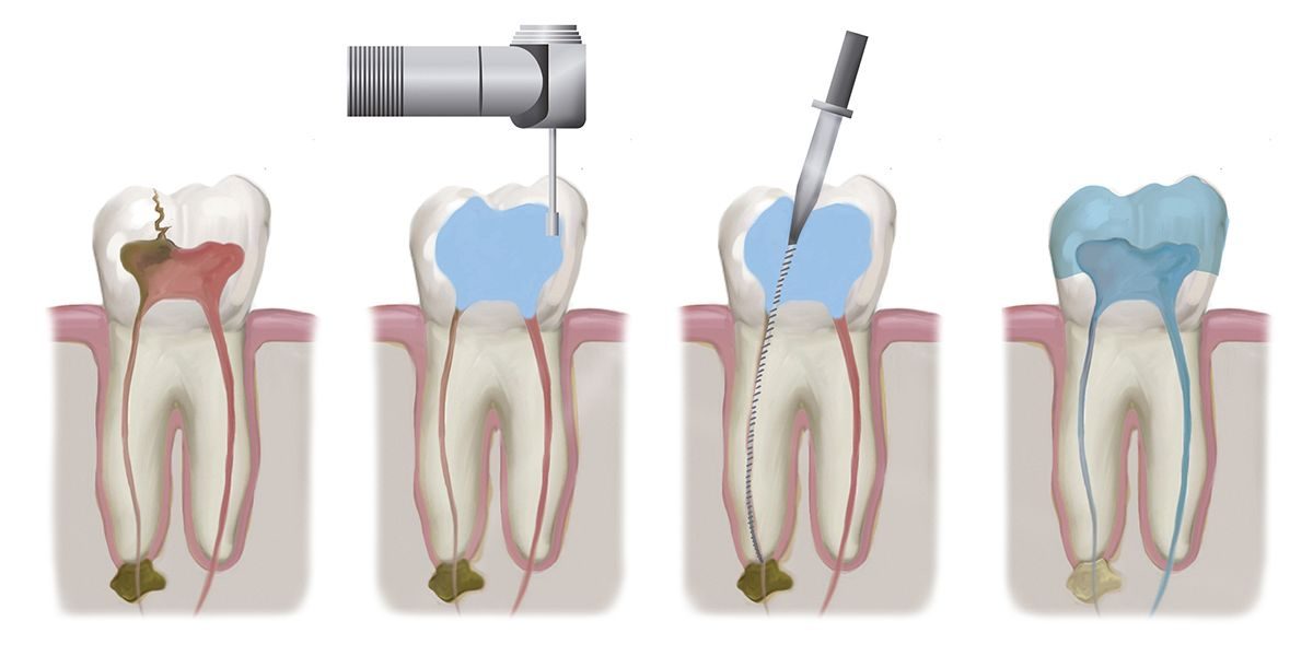 Why Root Canal Treatment Why Root Canal Treatment