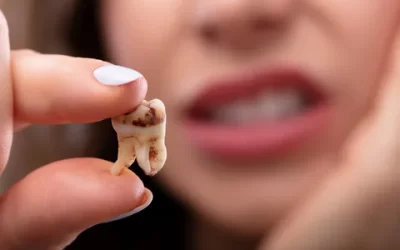 What is a Tooth Decay?