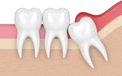 What is Wisdom Teeth?