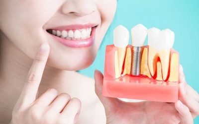 How Should Oral Care Be Taken After Implant Treatment?