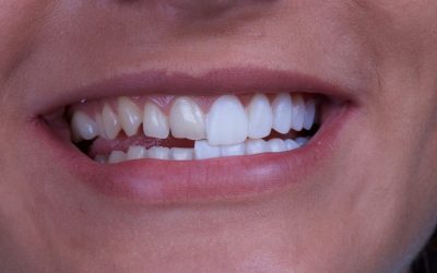 How Much is a Full Set of Veneers Cost in Turkey