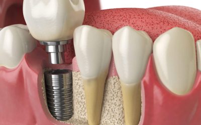 What are the Different Types of Dental Implants