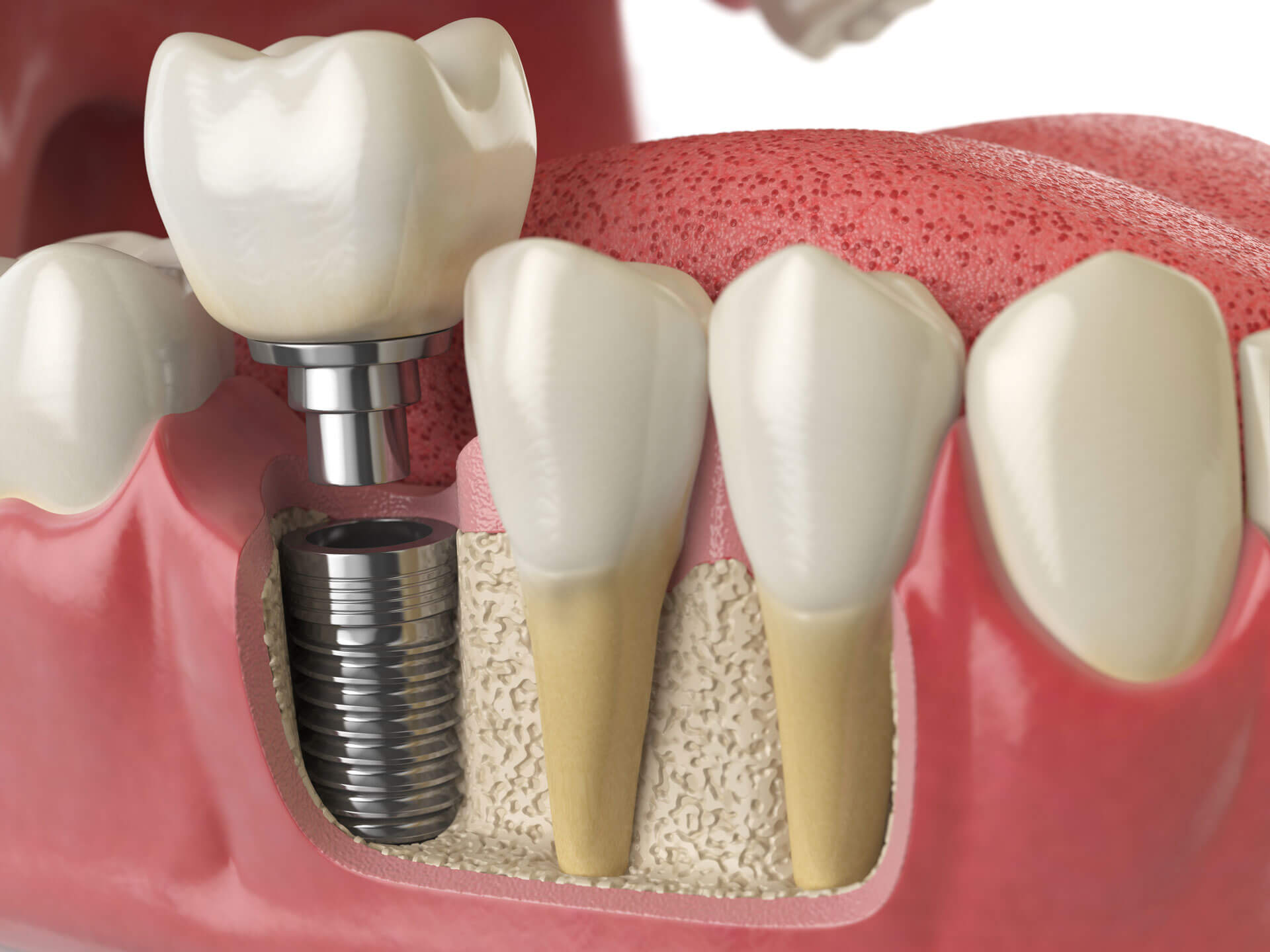 dental implants in turkey