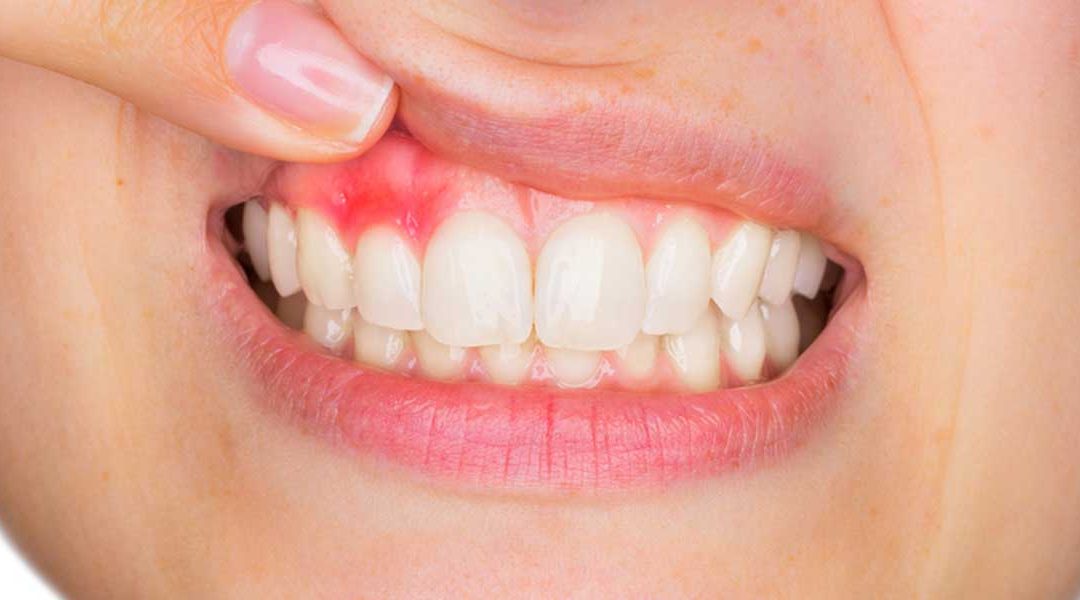 Diş Eti Hastalıkları Nelerdir? (Periodontoloji)