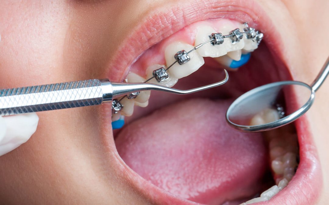 Ortodonti Tedavisi Nedir?(Diş Teli)