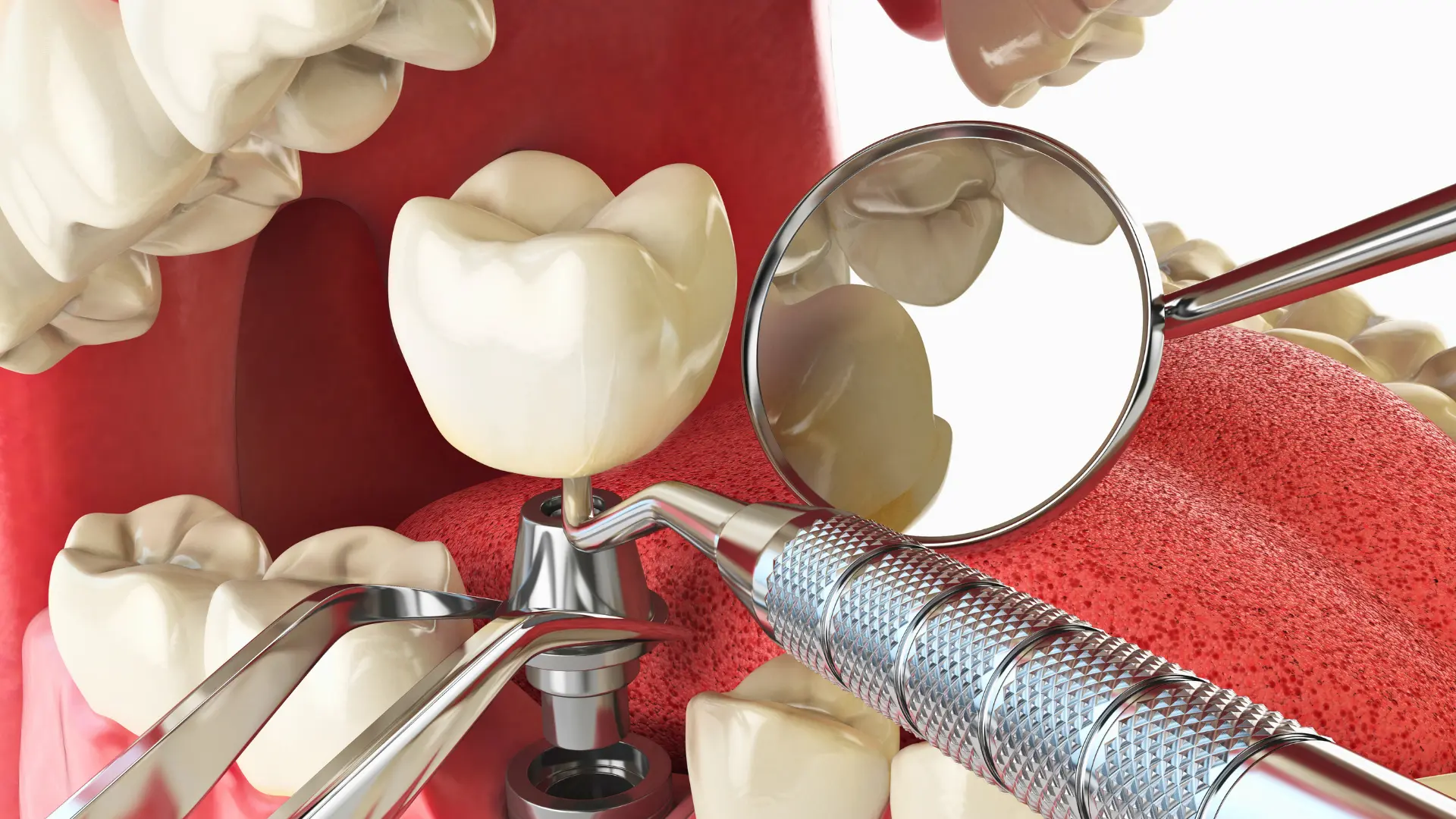arka diş implantı nasıl yapılır