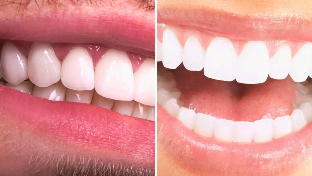 zirkonyum mu lamine mi