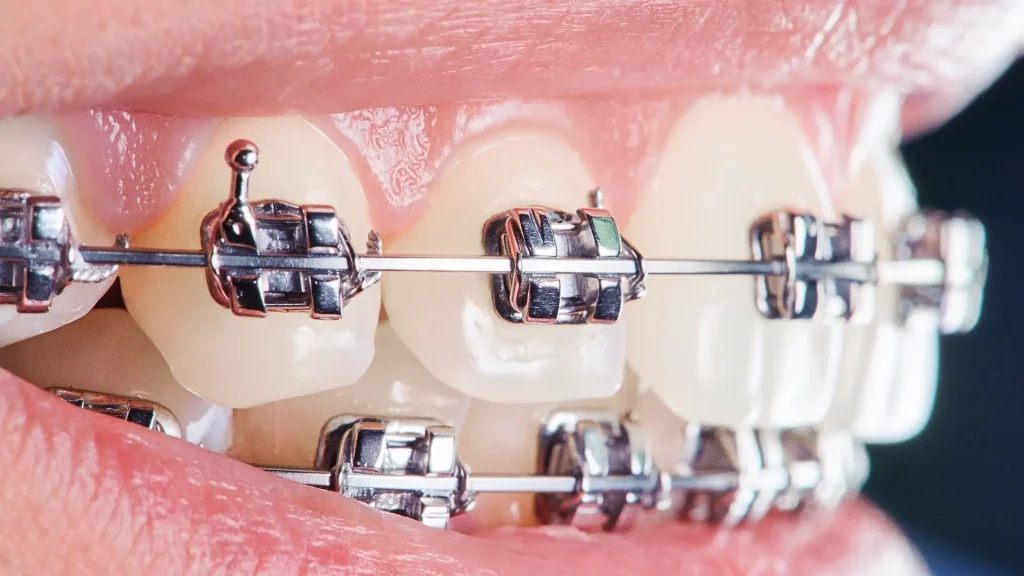 diş üstü tel tedavisi