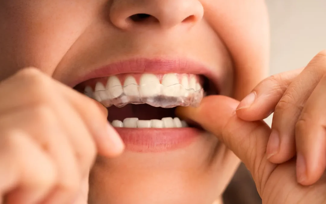 Şeffaf Plak (Invisalign) Nedir? Avantajları, Süreci ve Önemli Bilgiler