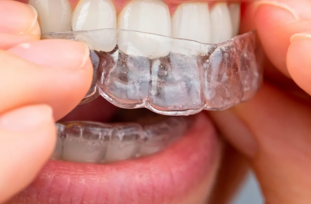 istanbul şeffaf plak yapan diş kliniği