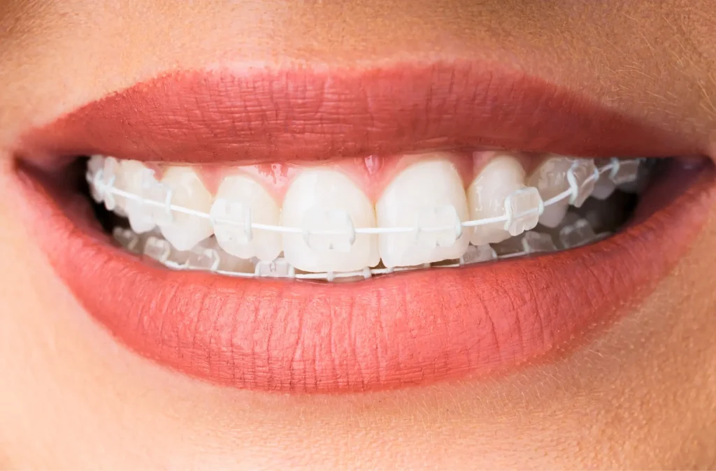 neden diş teli taktırmalısınız