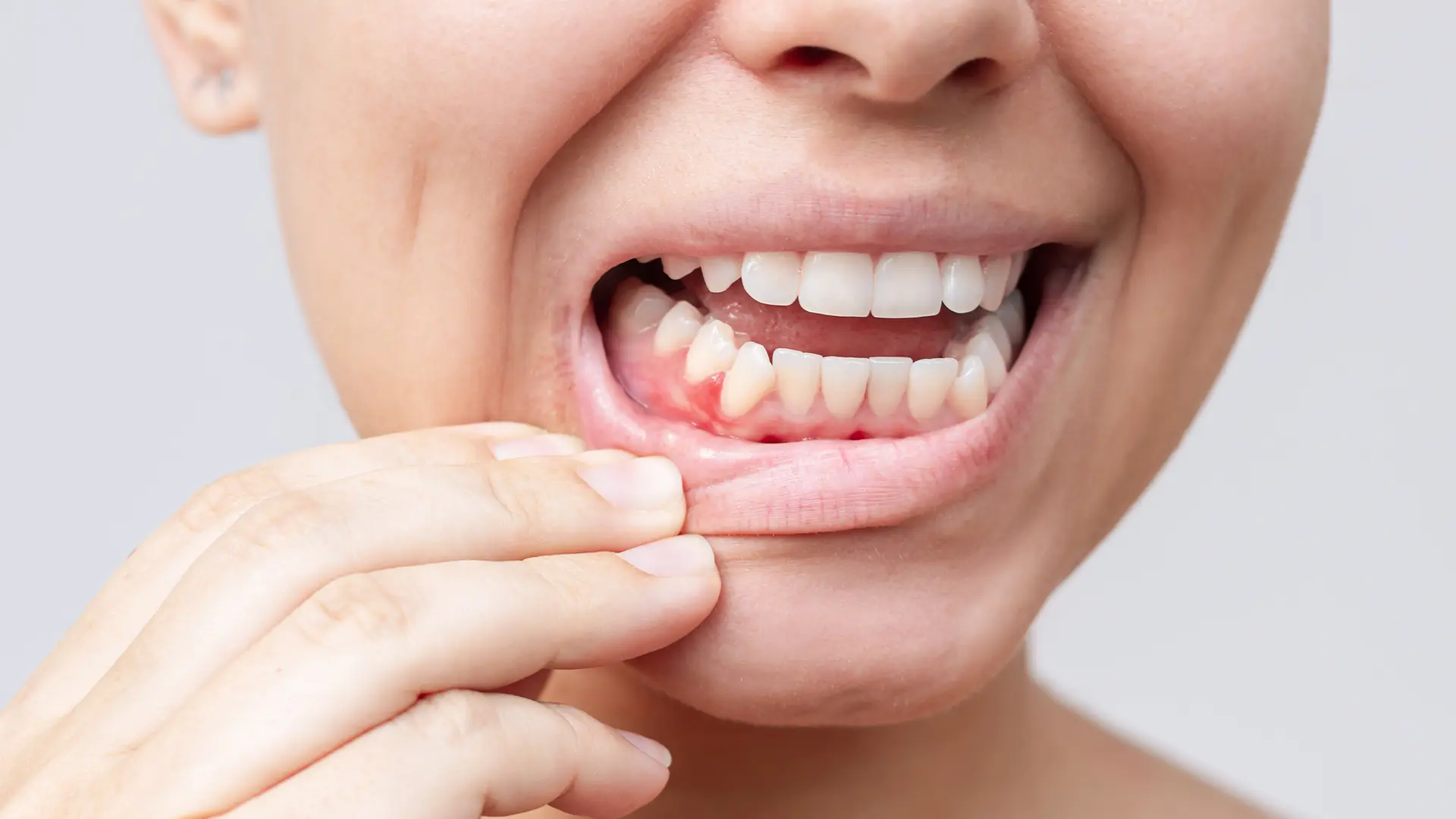 Periodontoloji (Diş Eti Hastalıkları)