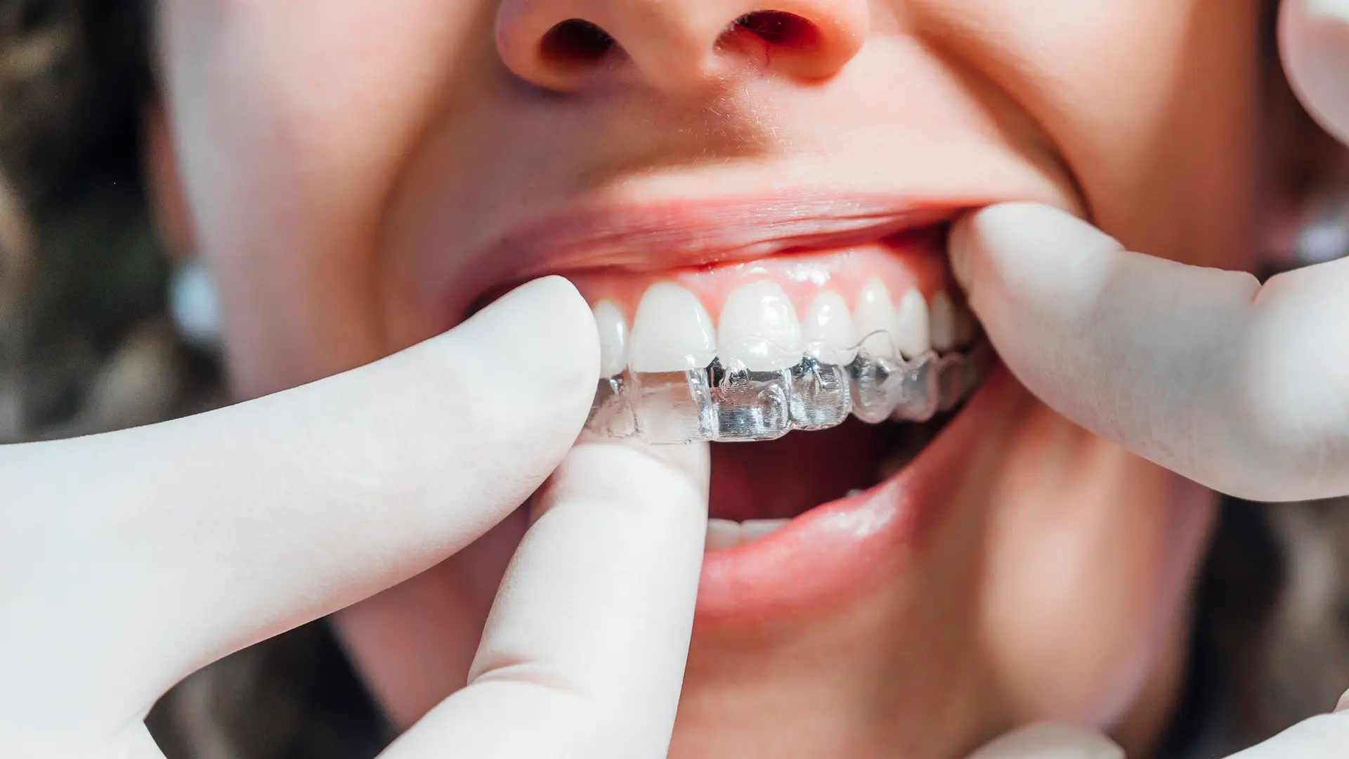 Invisalign Tedavisi