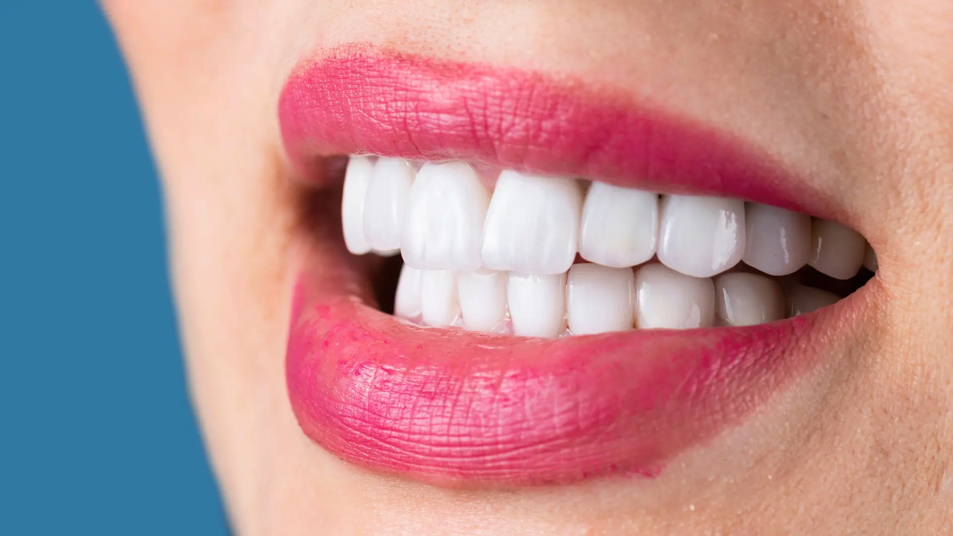 full ağız implant