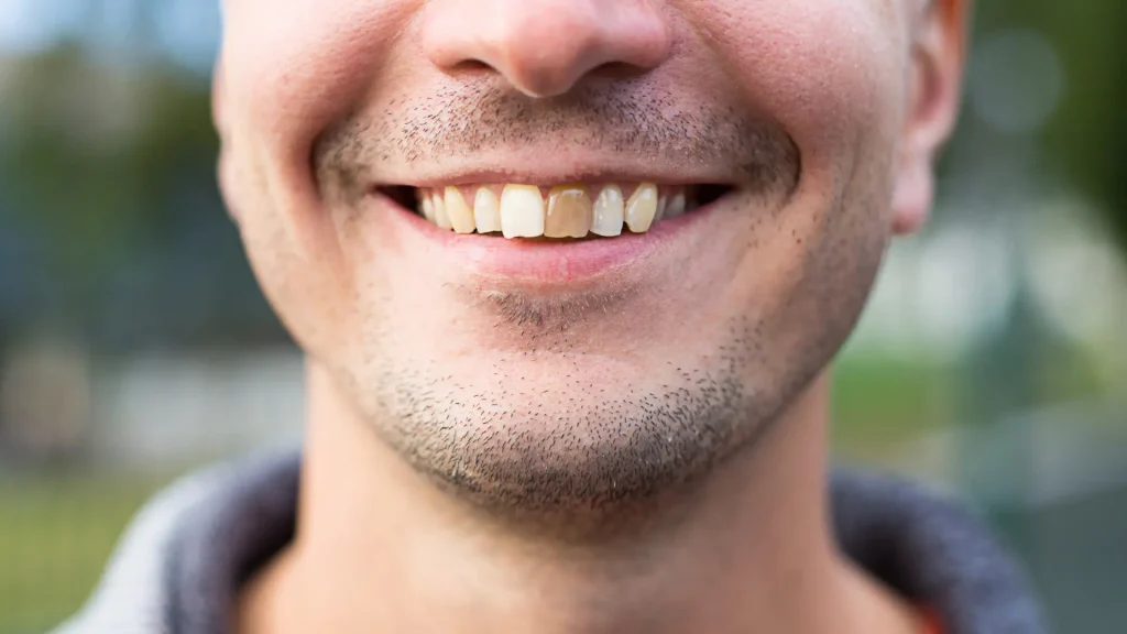 Diş Sararması Neden Olur Diş Sararması Nasıl Geçer