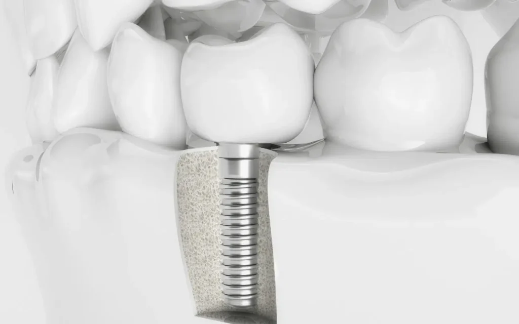 İmplant Tedavisi Ne Kadar Sürüyor?