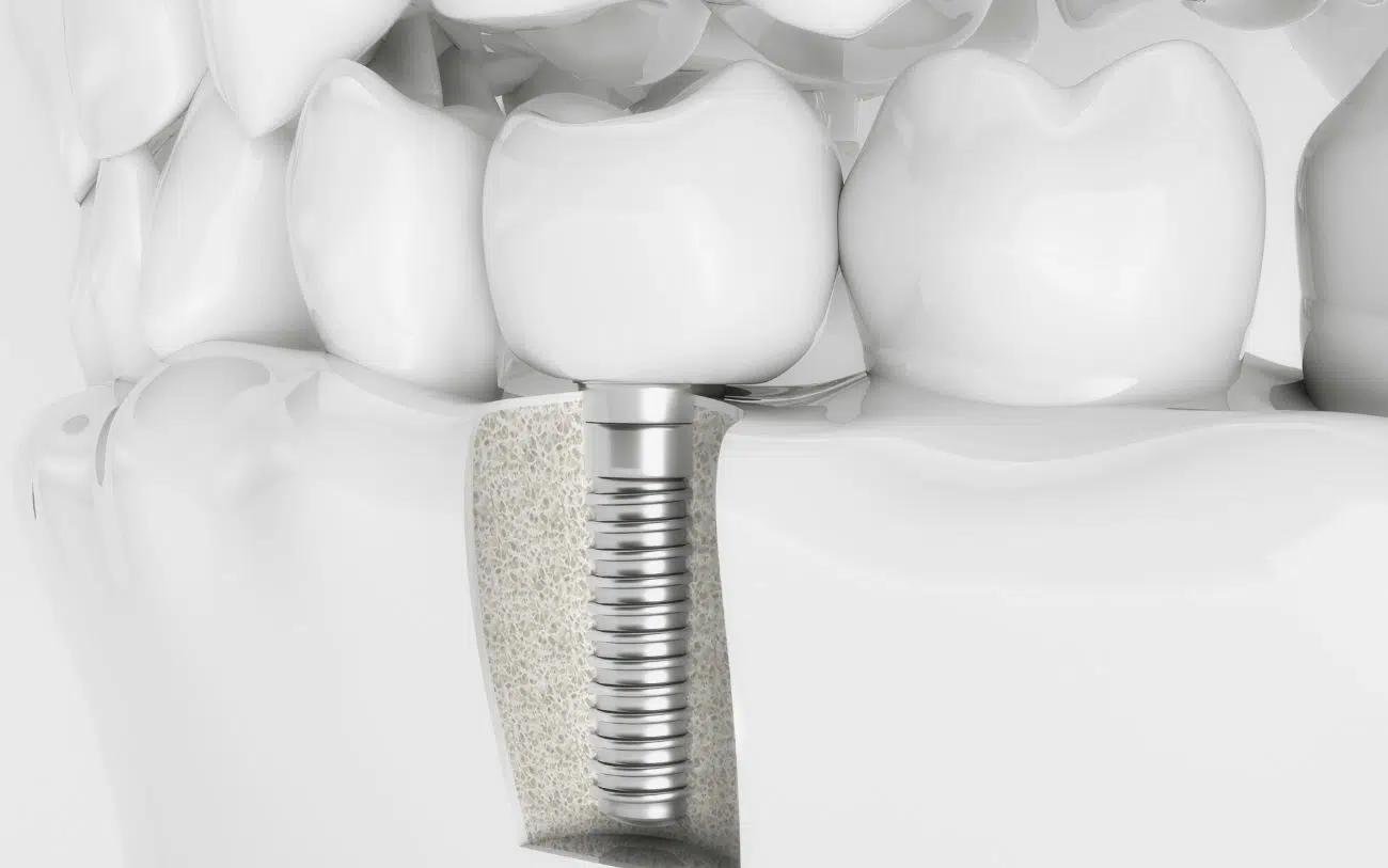 İmplant Tedavisi Ne Kadar Sürüyor?