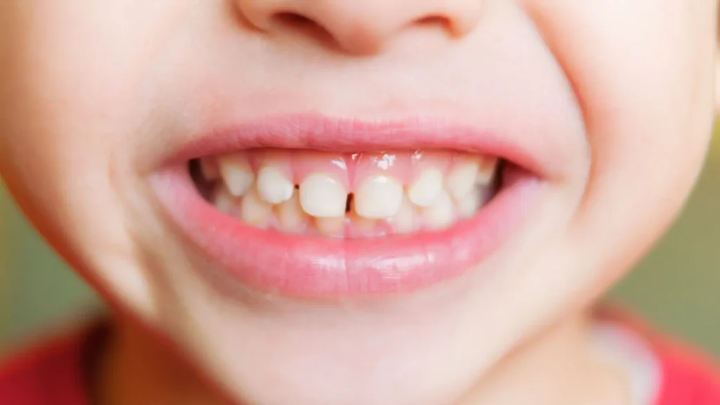 Çocuklarda Süt Dişleri Ne Zaman Dökülür