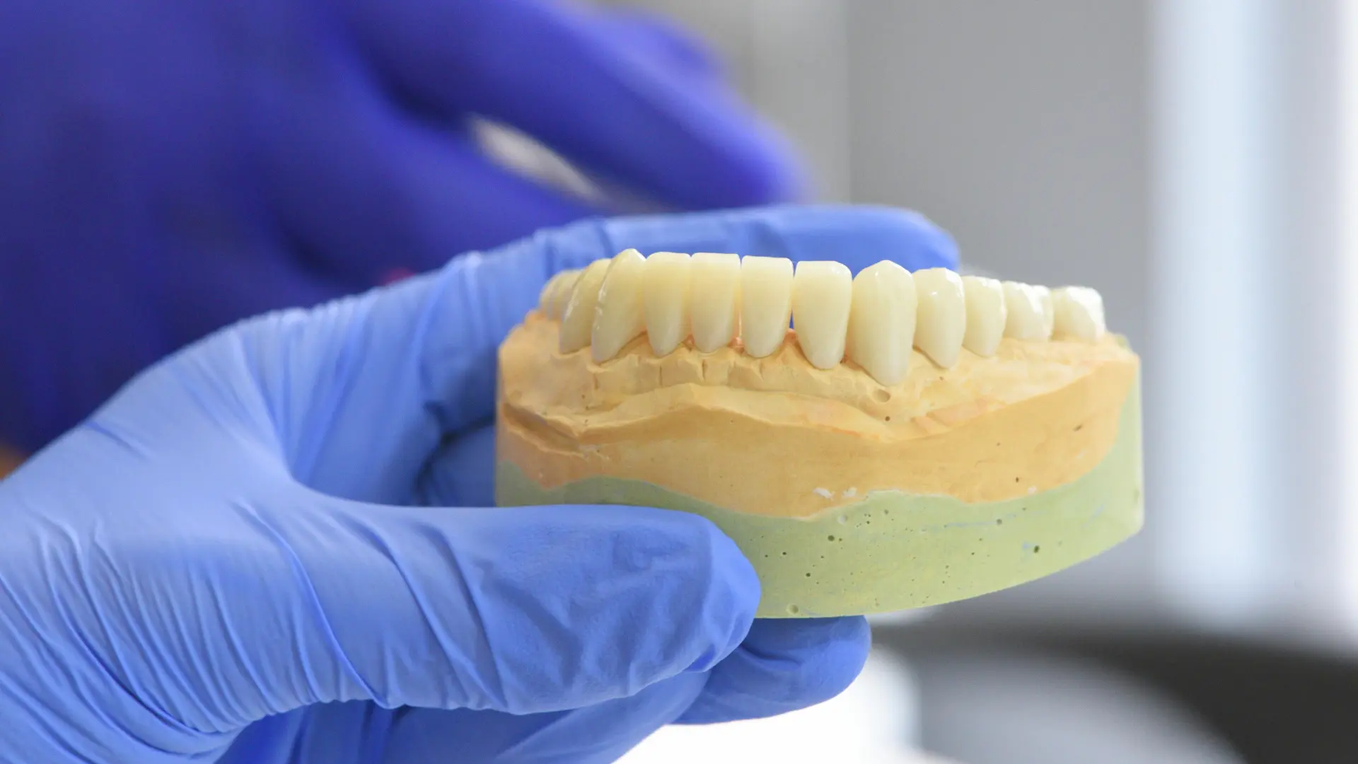 İmplant Diş Bakımı Nasıl Yapılır? (5 Altın Kural)