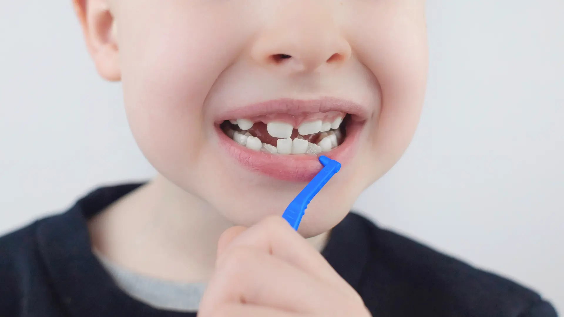 Diastema (Diş Arası Boşluk) Tedavisi: Hangi Yöntemler Var?