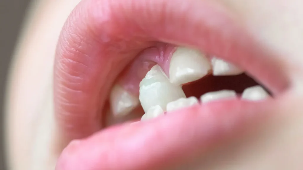 Diş Dolgusu Düştü Ne Yapmalıyım