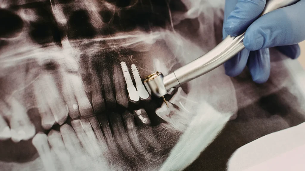 implant diş kimlere yapılmaz